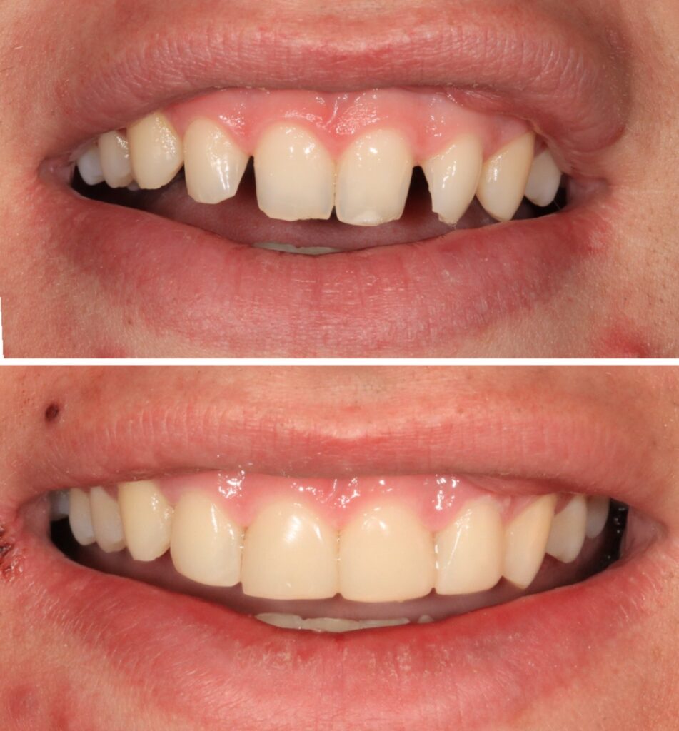 veneers to close gaps - Dentist Ryde