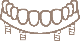 Full Mouth Implants Ryde