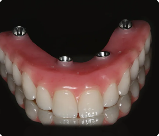 Full Mouth Implants Ryde