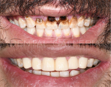 Dental Implants Putney