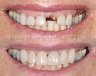 Dental Check Up and Clean Ryde