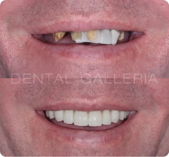 Dental Check Up and Clean Putney