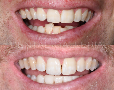 Dental Implants Ryde
