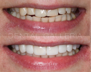 Dental Implants Putney