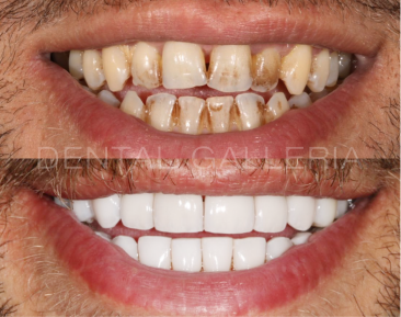 Dental Implants Putney