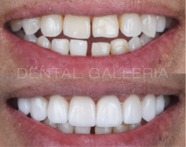 Dental Implants Putney