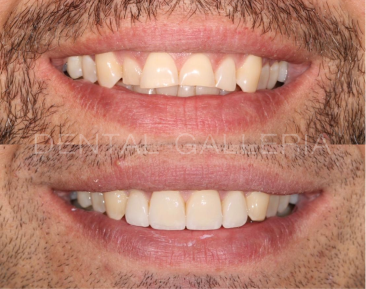 Dental Implants Putney