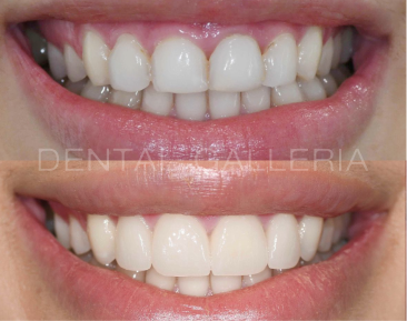 Dental Implants Putney