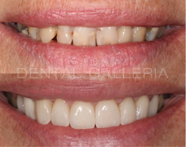 Dental Implants Putney