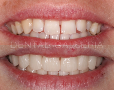 Dental Implants Ryde