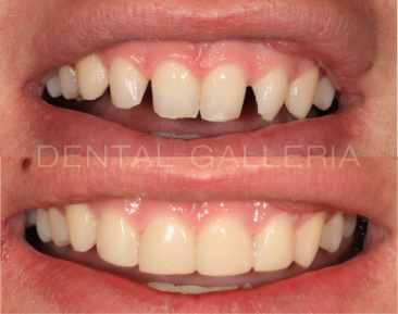 Dental Implants Ryde