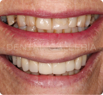 Full Mouth Implants Ryde