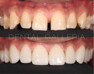 Dental Implants Ryde