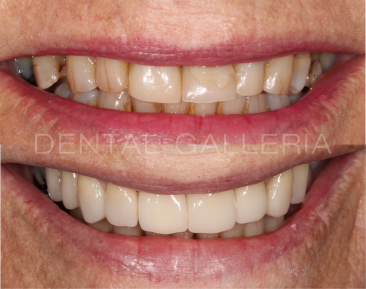 Dental Implants Ryde