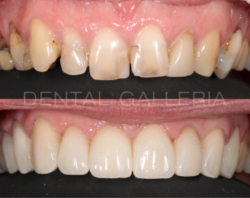 Dental Implants Ryde