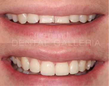 Dental Implants Ryde