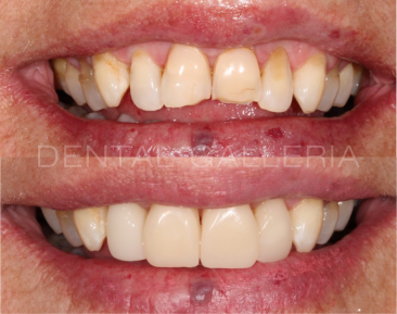 Dental Implants Ryde