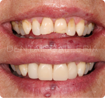 Full Mouth Implants Ryde