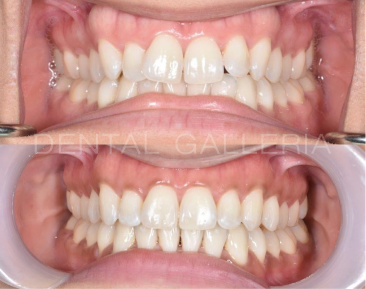 Dental Implants Ryde