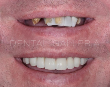 Dental Check Up and Clean Ryde