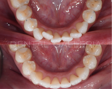 Dental Implants Ryde