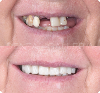 Full Mouth Implants Ryde