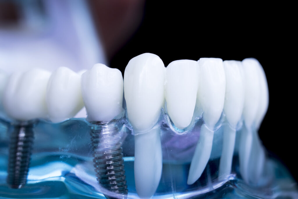 Dental implants in Putney & Ryde