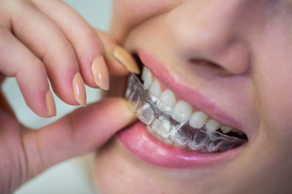Invisalign Dentist Putney