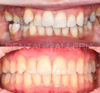 Invisalign 4 1