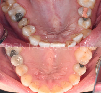Invisalign 5 1