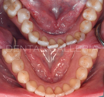Invisalign 6 1