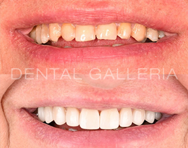 before and after porcelain veneers1