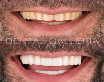 before and after porcelain veneers2