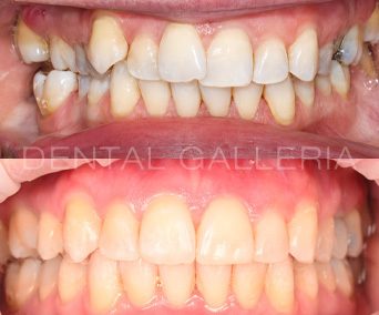 Invisalign-4