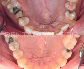 Invisalign-5