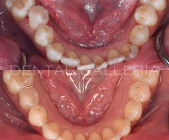 Invisalign-6